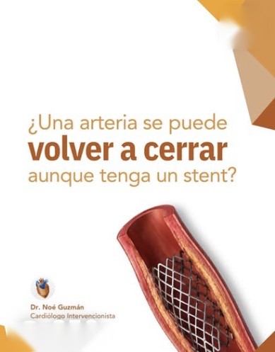 Reel: ¿Una arteria se puede volver a cerrar aunque tenga un stent?