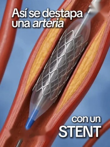 Reel: Así se destapa una arteria con un stent